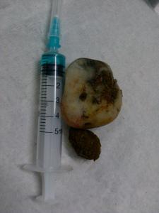 腸道異物